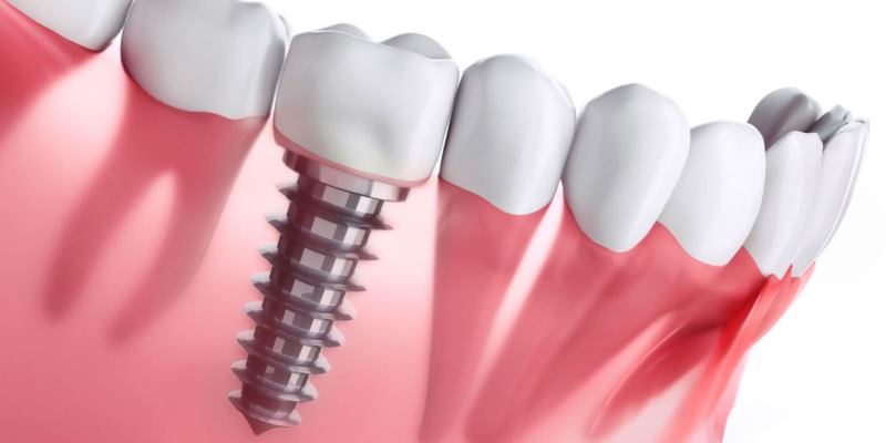 ایمپلنت چیست ؟ 2 ایمپلنت چه مزایایی دارد