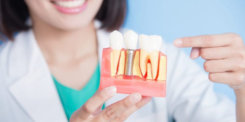 کاشت دندان و جراحی ایمپلنت در دوران بارداری امکان پذیر است ؟