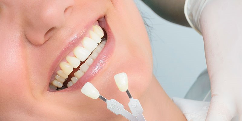 لمینت دندان برای چه کسانی مناسب است ؟