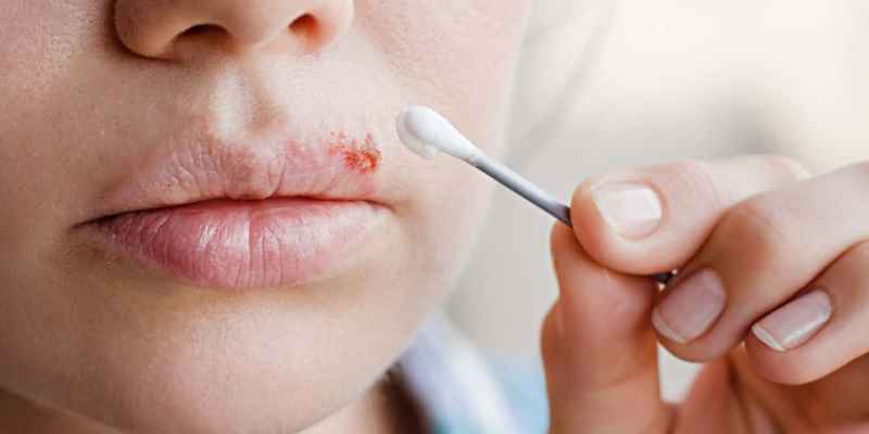 آیا تبخال لب مشکل آفرین است ؟