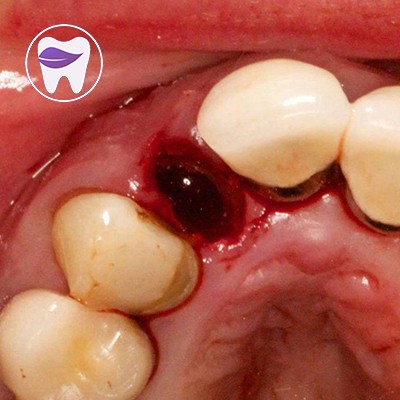 درای ساکت یا حفره خشک دهانی