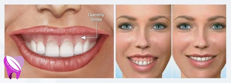 چگونه میتوان لبخد لثه ای را اصلا ح کرد ؟