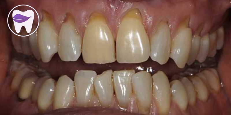 علل ایجاد تحلیل لثه کدام است ؟