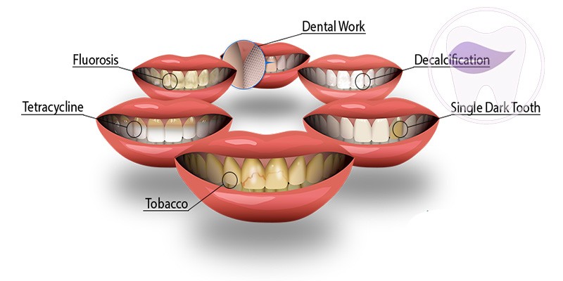 تغییر رنگ دندان چه زمانی ایجاد میشود ؟ 2 تغییر رنگ دندان چه زمانی ایجاد میشود ؟