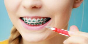 مسواک بین دندانی برای افراد دارای ارتودنسی مناسب است