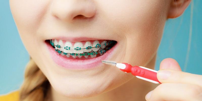 مسواک بین دندانی برای افراد دارای ارتودنسی مناسب است