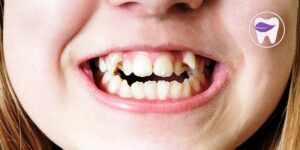 دندان اضافه کودکان چه مشکلاتی را میتواند ایجاد کند