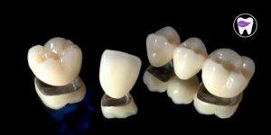 تاج دندان به چه معناست و انواع آن کدام است ؟