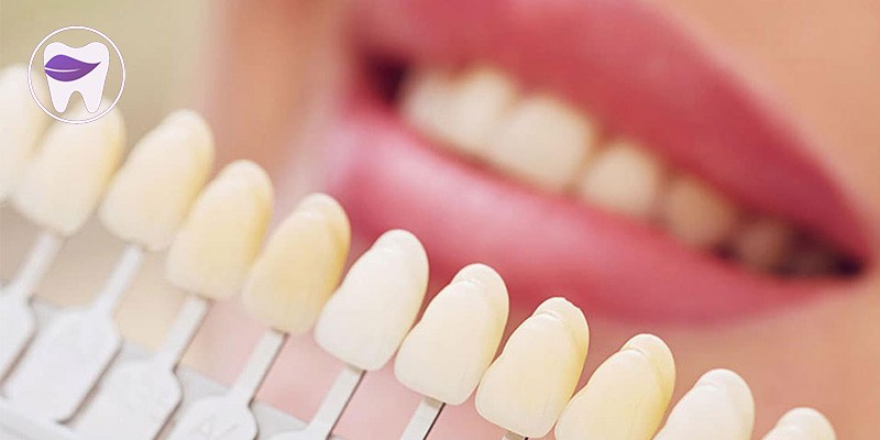 مراقبت از لمینت دندان و باید ها و نبایدهایی که باید بدانید