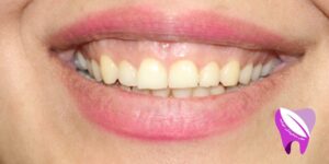 لبخند لثه ای چه مشکلاتی را به همراه دارد ؟
