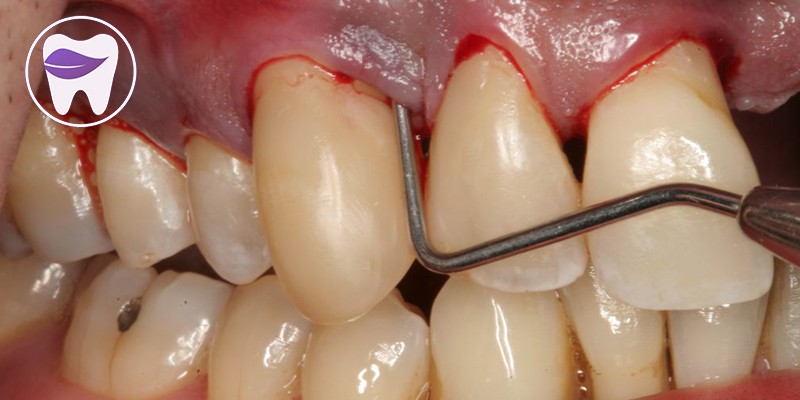 تحلیل لثه یا عقب رفتن لثه چه معنایی دارد ؟