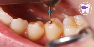 پر کردن دندان چگونه است ؟