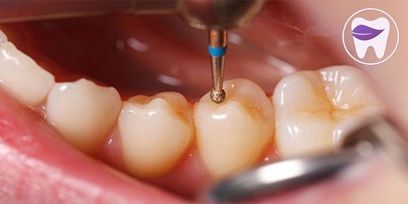 پر کردن دندان چگونه است ؟