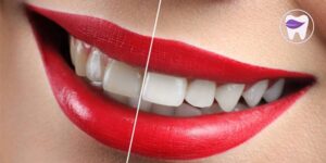 طرح لبخند هالیوودی چه ویژگی هایی دارد ؟
