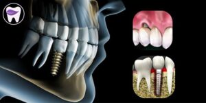 پوکی استخوان و ایمپلنت رابطه ای کامل با یکدیگر دارند