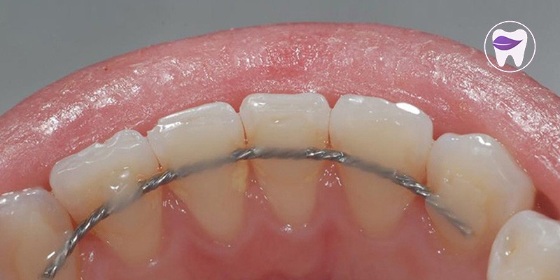اسپلینت دندان چه روش های درمانی را شامل میشود ؟