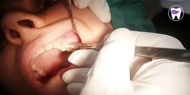 جراحی اپیکو چه زمانی لازم است ؟