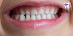 کراس بایت دندان چگونه درمان میشود ؟