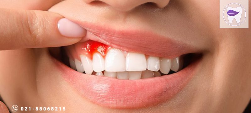 ار عفونت لثه چه اطلاعاتی دارید ؟