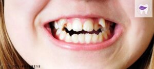 دندان نیش نهفته و مشکلاتی که به همراه دارد ؟