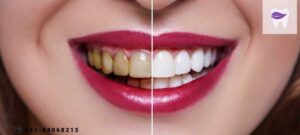 ونیر کامپوزیت چه کاربردی در اصلاح لبخند دارد ؟