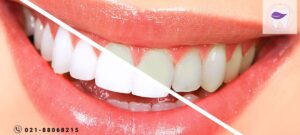 علت تغییر رنگ کامپوزیت دندان چیست ؟