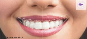 قیمت لمینیت دندان در سال جدید چگونه است ؟
