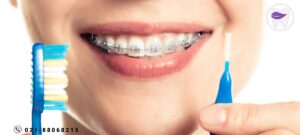 از مسواک ارتودنسی چه اطلاعاتی دارید؟