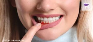 علل ایجاد خونریزی لثه کدام است ؟