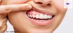 تخلیه آبسه دندان چگونه است ؟