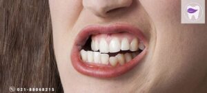 از علت سایش دندان چه اطلاعاتی دارید؟