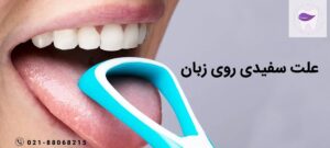 علت سفیدی روی زبان چیست و چه درمانی دارد ؟