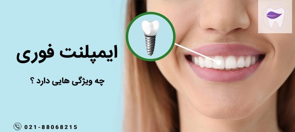 ایمپلنت فوری چه ویژگی ها و نکاتی دارد ؟
