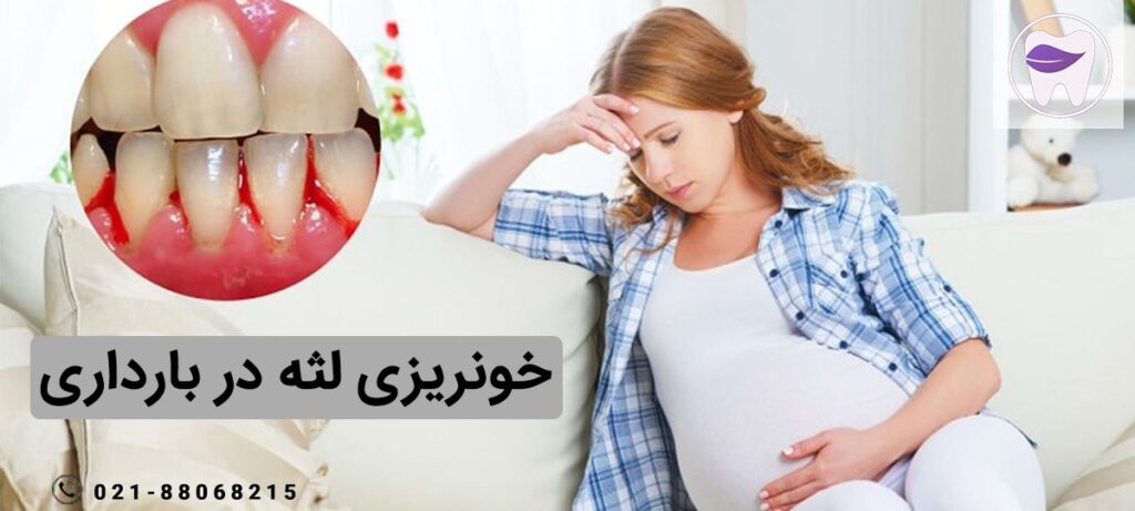 علت و درمان خونریزی لثه در بارداری چیست ؟