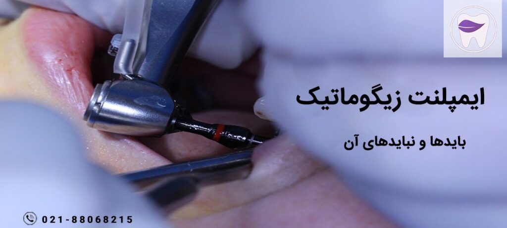 همه چیز در رابطه با ایمپلنت زیگوماتیک کچه زمانی مورد استفاده است ؟