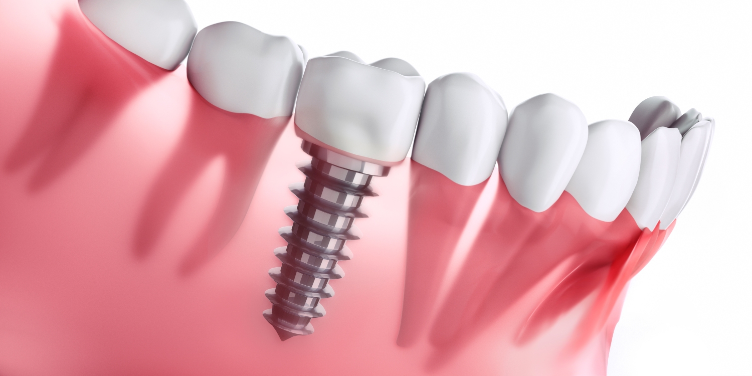 ایمپلنت دیجیتال چیست؟ همه چیز درباره فناوری مدرن کاشت دندان