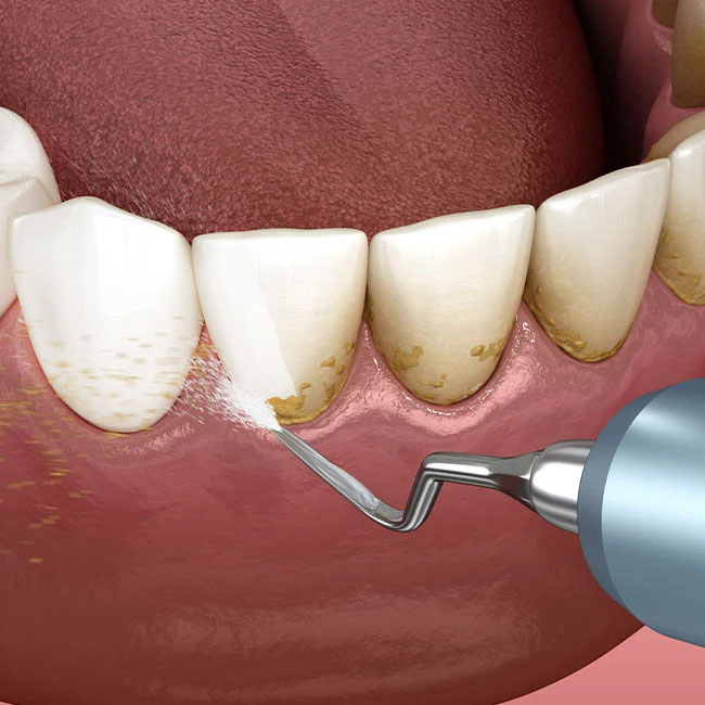 جرم گیری دندان در یوسف آباد تهران