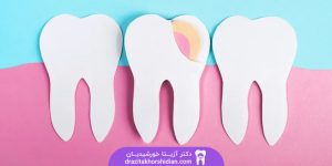 جراحی دندان عقل در یوسف آباد تهران