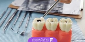 ترمیم و پر کردن دندان در یوسف آباد تهران