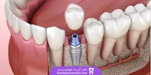 قیمت ایمپلنت کره ای در یوسف آباد تهران