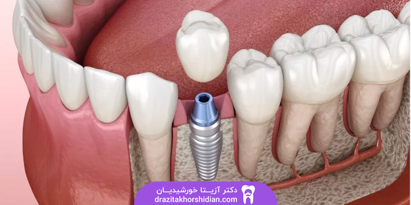 قیمت ایمپلنت کره ای در یوسف آباد تهران
