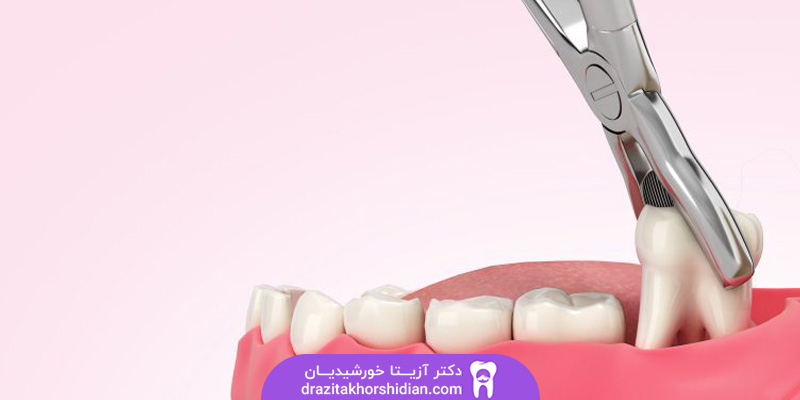 کشیدن دندان در یوسف آباد تهران
