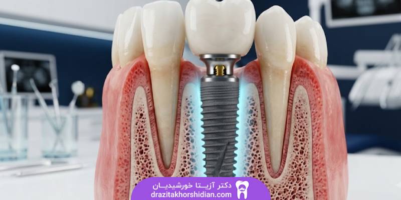 طول عمر ایمپلنت دندان