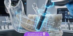 کاشت دندان بدون جراحی