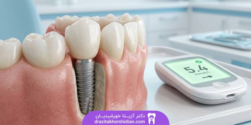رابطه ایمپلنت و دیابت