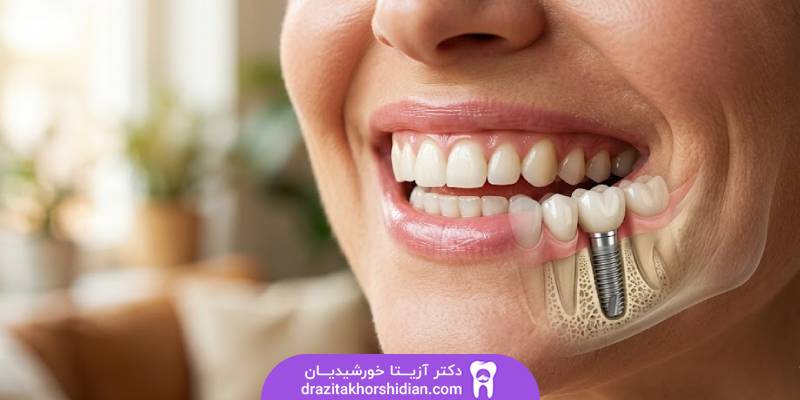 جوش خوردن ایمپلنت