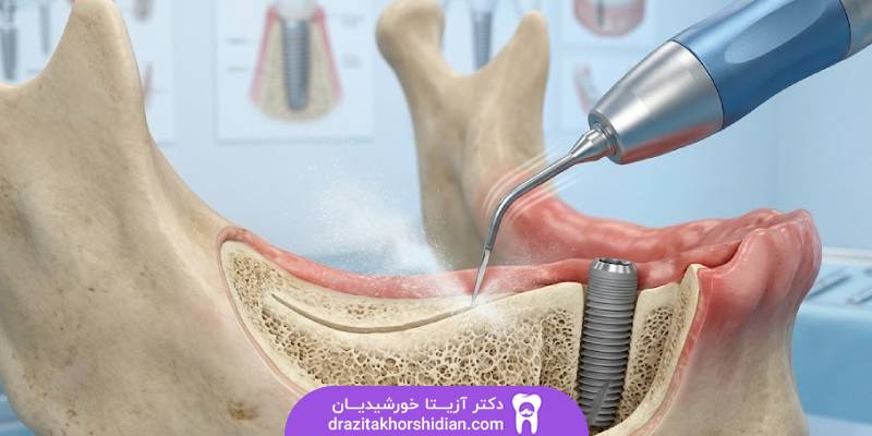 جراحی ریج اسپلیت