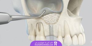 جراحی سینوس لیفت فک بالا