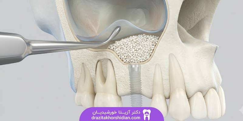 جراحی سینوس لیفت فک بالا