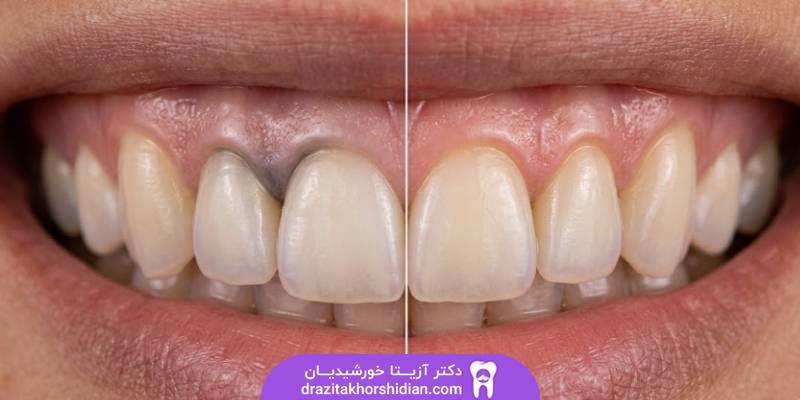 اباتمنت کاستوم یا پیش ساخته